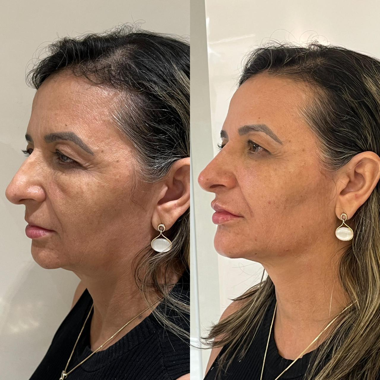 Harmonização Full Face