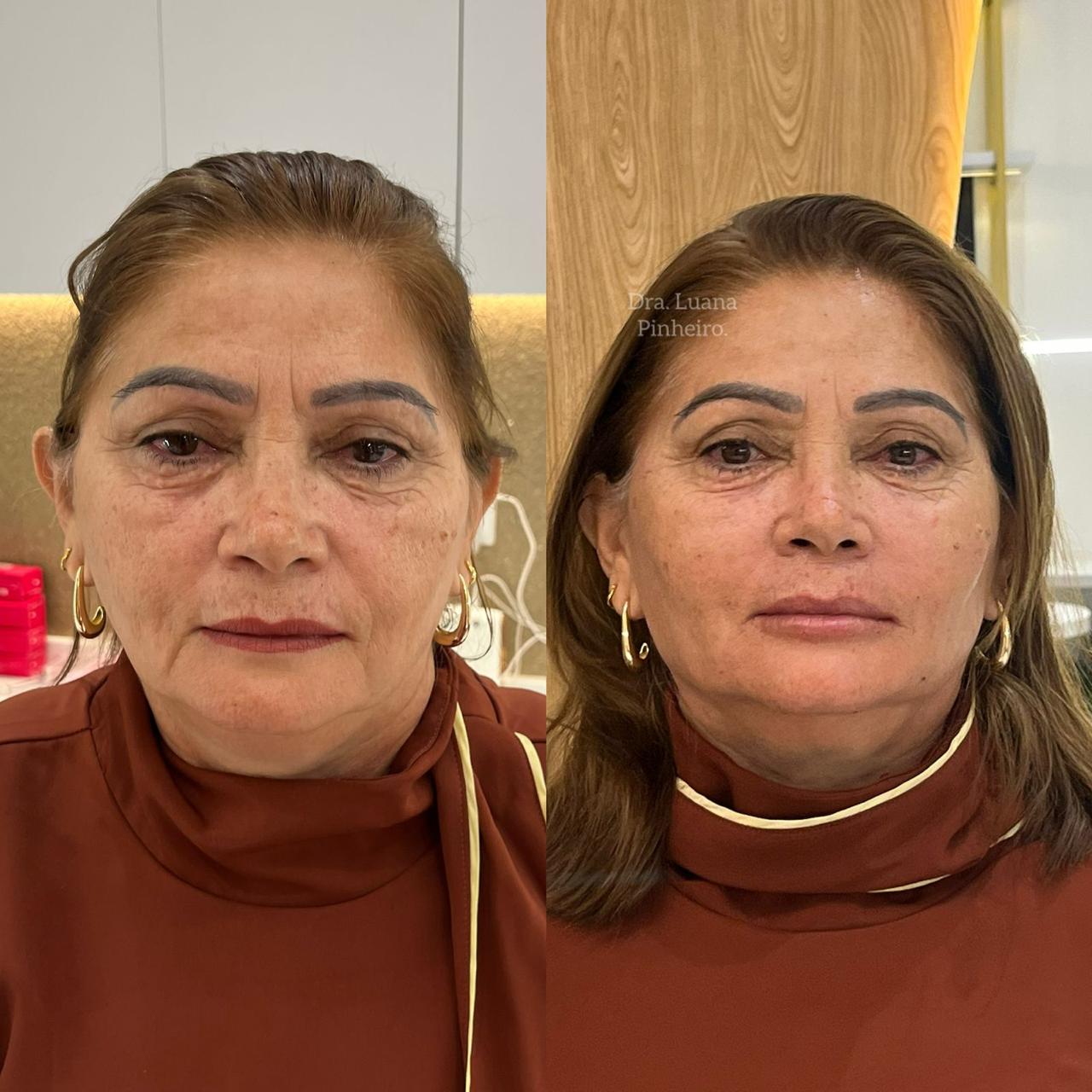 Skinbooster