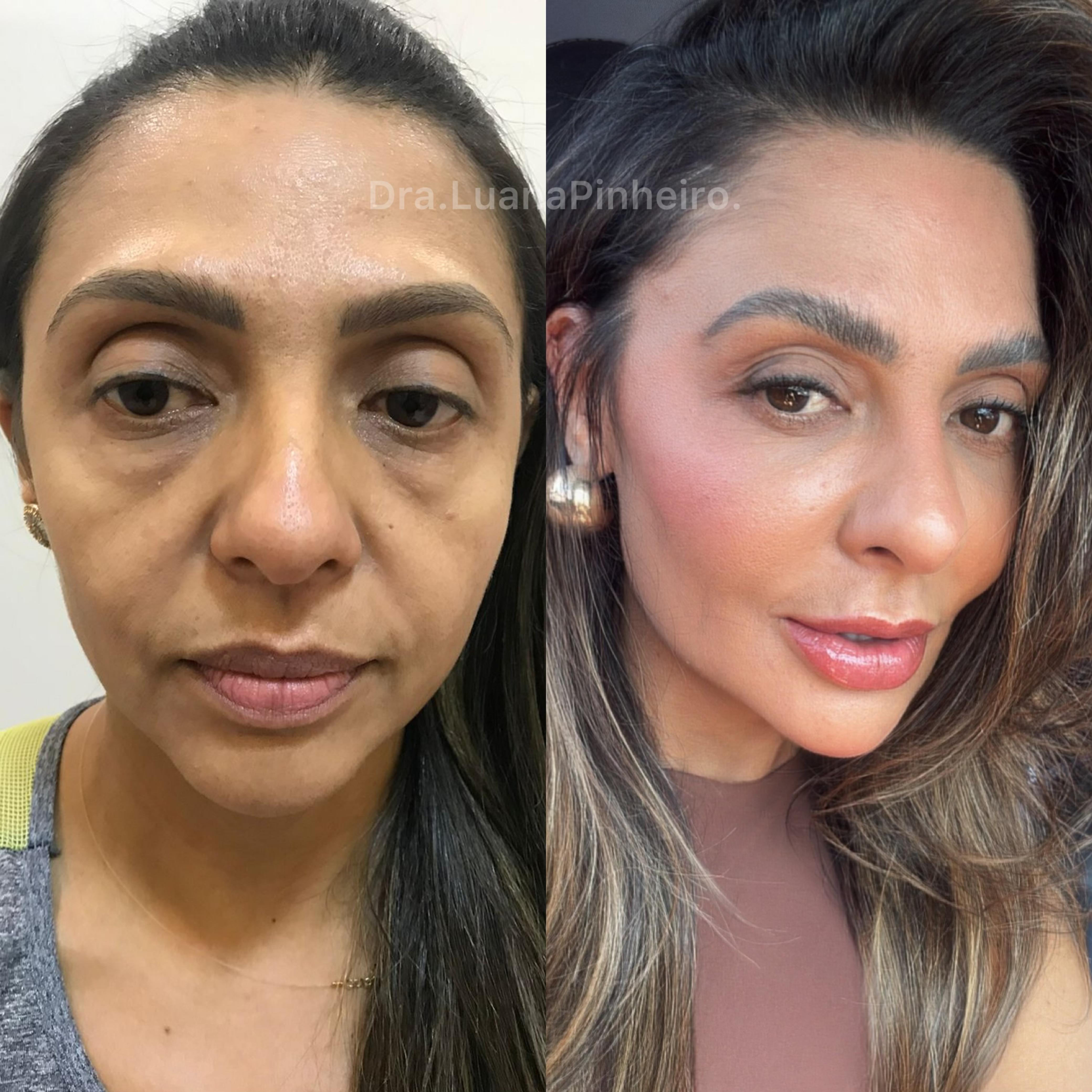 Harmonização Full Face