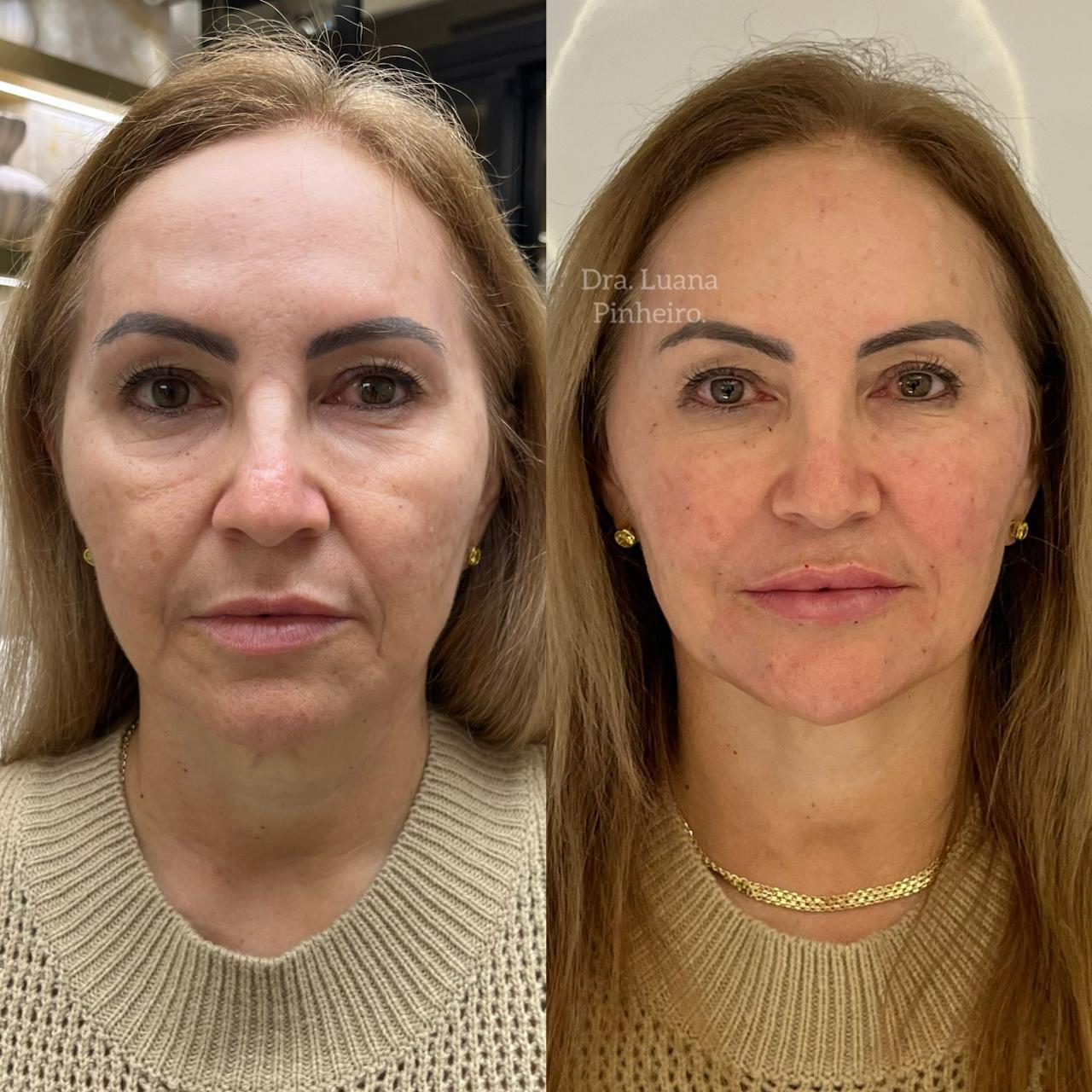 Harmonização Full Face